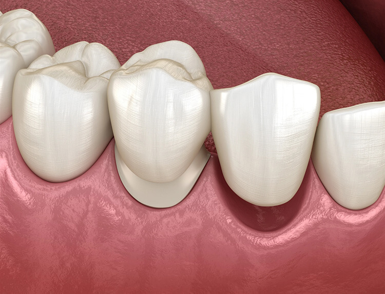 Image showcasing restorative dental services, such as fillings and crowns, at Burlington Family Dental.